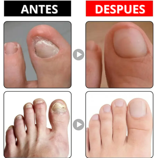 ToeNailPlus 2x1 | Aceite para Hongos en las Uñas